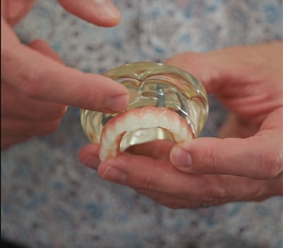 Implant Dentures Permanent Teeth