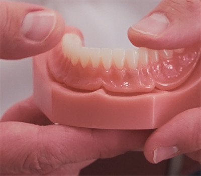 What is an Implant over Denture