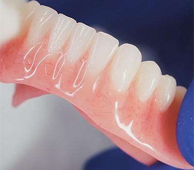 What is a Denture Reline